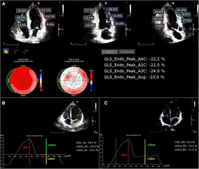 Evaluation of the relationship between left atrial stiffness, left ventricular stiffness, and left atrioventricular coupling index in type 2 diabetes patients: a speckle tracking echocardiography study